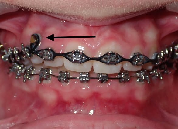 alternative surgical options - TADs
