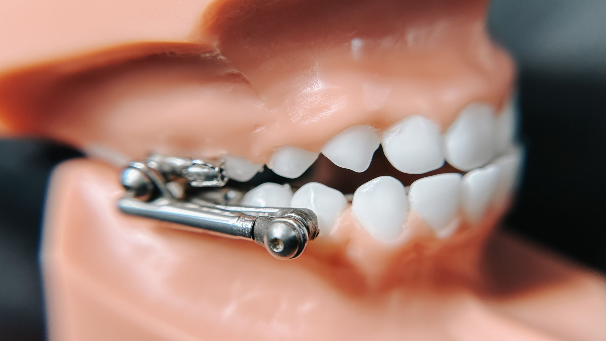 Carriere Appliance Apple Creek Orthodontics