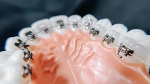 lingual braces on model teeth