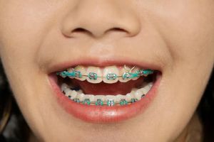 Elastics for Braces - Everything You Need to Know